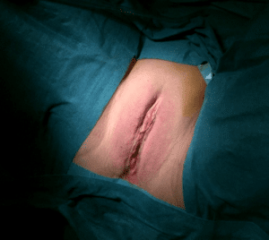 Labioplastia de reducción, una cirugía estética frecuente