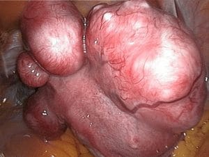 Síntomas de los miomas uterinos