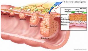 Clasificación de Dukes para el cáncer de colon