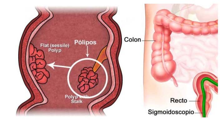 Qué son los pólipos intestinales - Sanibook. Consejos de salud