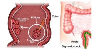 Qué son los pólipos intestinales