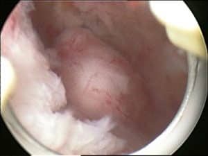 Miomas
