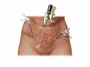 Qué es la laparoscopia ginecológica