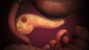 Primera Terapia Contra el Cáncer de Páncreas