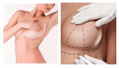 La Mastopexia la cirugía de elevación de mamas