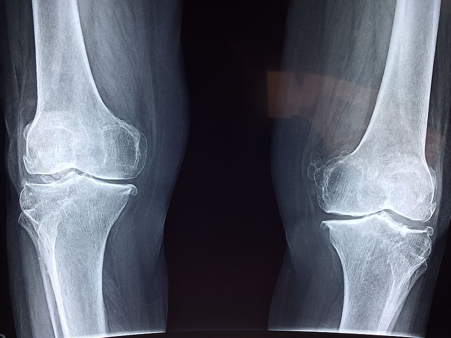 Ácido hialurónico para la artrosis en la rodilla. Radiografía