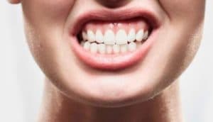 Bruxismo y dolor de cabeza ¿Se relacionan? Su tratamiento de fisioterapia