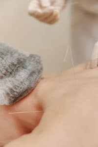 La acupuntura