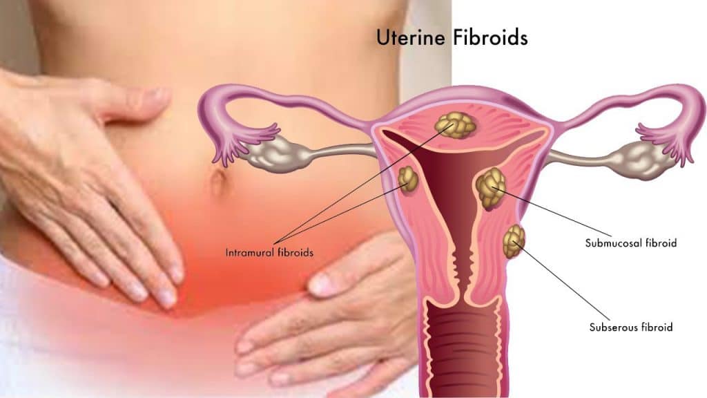 Mioma uterino. Ilustración de su ubicación