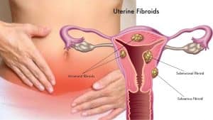Mioma uterino. Qué es