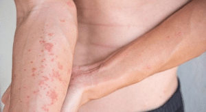 Dermatitis atópica