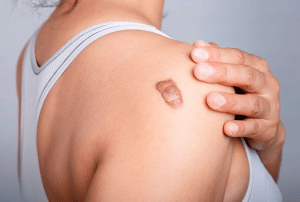 Las cicatrices queloides