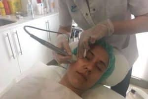Optimización facial con láser fraccionado