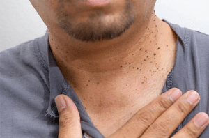 Queratosis seborreica: Todo lo que necesitamos saber
