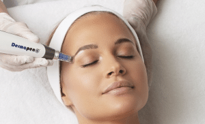 Microneedling: Todo lo que necesitas saber
