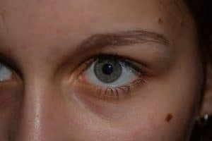 Lunares en la piel: Tipos, Características y Medidas Preventivas