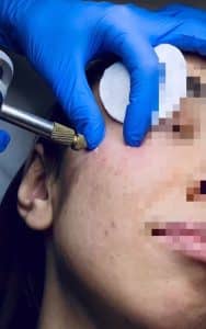 Verrugas Víricas Faciales