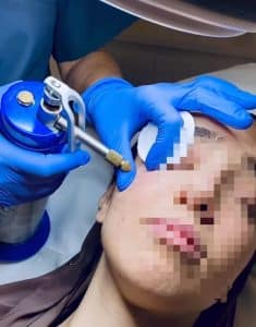 Verrugas víricas faciales: Todo lo que debemos saber