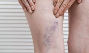 Esclerosis de varices: Todo lo que debemos saber