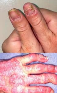 Psoriasis: Todo lo que debemos saber sobre esta enfermedad crónica de la piel
