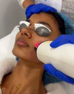 Láser IPL + FRAX: tratamiento combinado para rejuvenecer y mejorar la calidad de la piel