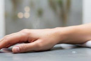 Hiperhidrosis y botox: una solución eficaz para el sudor excesivo
